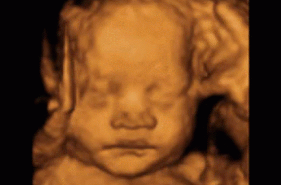 3D Pregnancy Scan