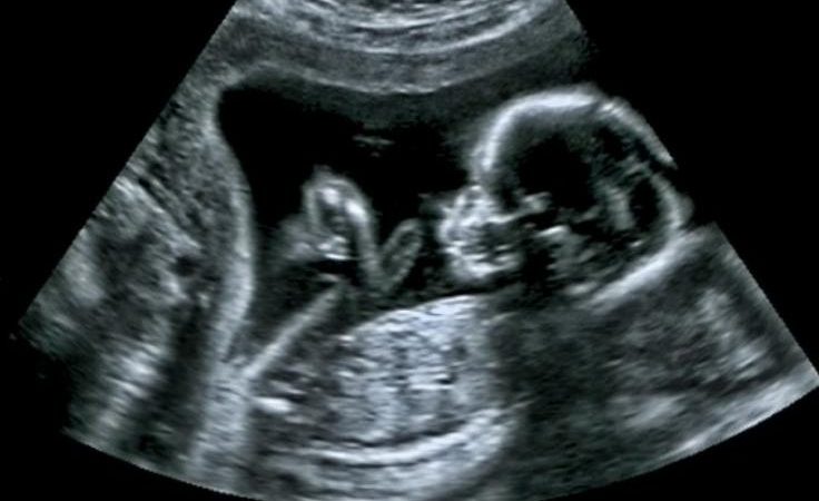pregnancy scan
