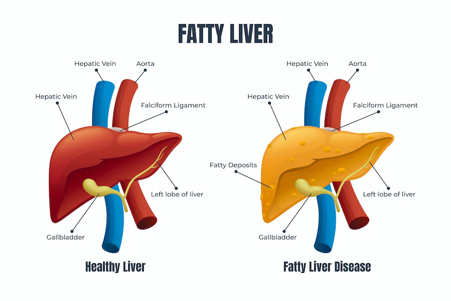 Fatty liver