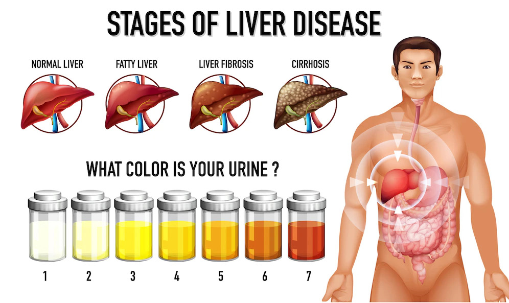 stages of liver disease