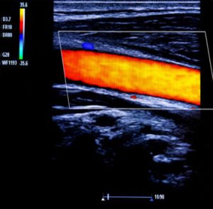 Arterial Doppler Ultrasound