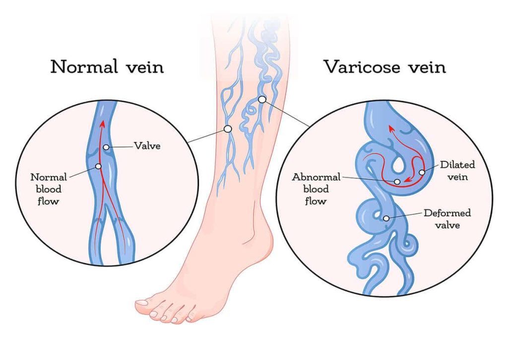 varicose veins