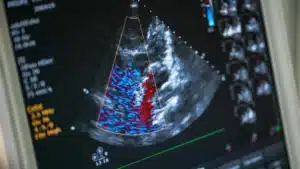 Echocardiogram