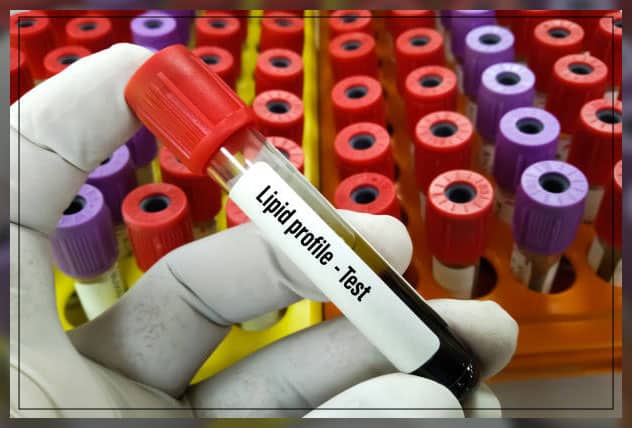 lipid profile test