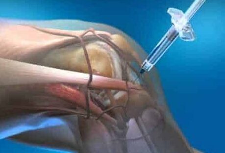 Private Joint Pain & Regenerative Clinic 3 Joint Drainage (Aspiration)